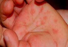¿Qué es el virus de boca, mano y pie que afecta a menores de 5 años?